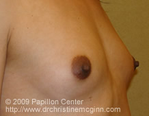 Breast Augmentation Pre-Op